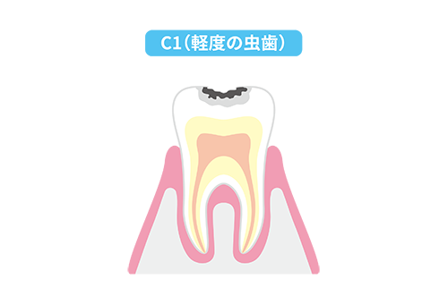 初期虫歯（C1）