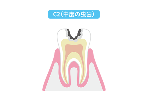 象牙質まで進行した虫歯（C2）