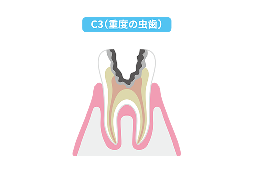 神経まで進行した虫歯（C3）