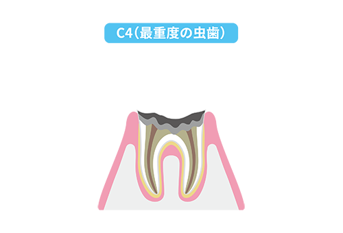 歯の根だけ残った虫歯（C4）